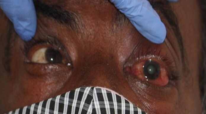 उत्तराखंड में ब्लैक फंगस से दो और मरीजों की मौत,सरकार ने ब्लैक फंगस की दवाई एम्फोटेरेसिन बी के उपयोग के लिए जारी की एस ओ पी